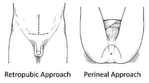 prostatectomia radical aberta