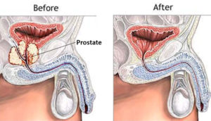 prostatectomia radical