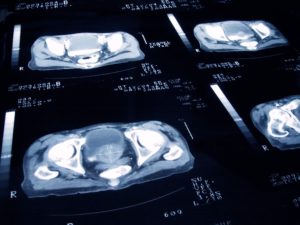 Tomografia Computadorizada de próstata