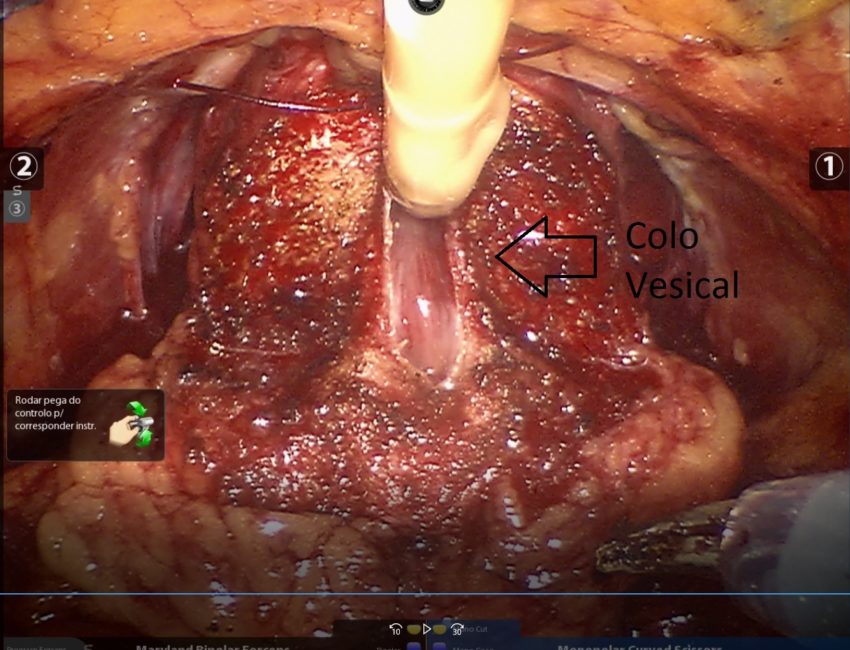 preservação de colo vesical 3