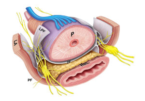 prostatectomia radical robotica