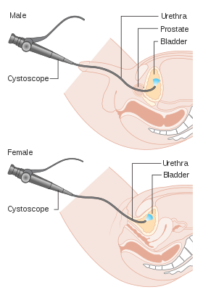 cistoscopia flexivel