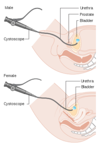 cistoscopia flexível