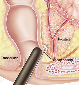 biopsia prostata prostatita de ciulin de lapte