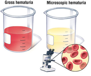 Sangue na urina