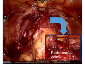 prostatectomia robótica resultados