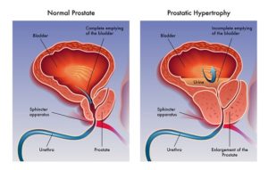 volume normal da prostata cm3