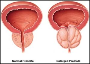 prostatite acuta cause