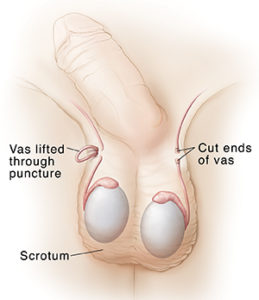 Vasectomia