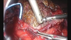cirurgia de pedras nos rins