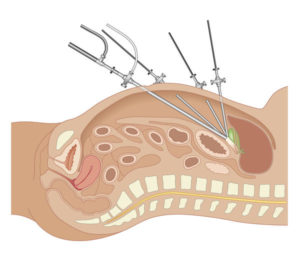 Ooforectomia esquerda laparoscópica com incisão única