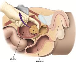 prostatectomia transvesical