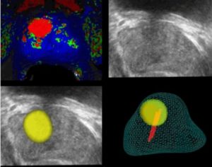 biopsia de prostata por fusão de imagem 