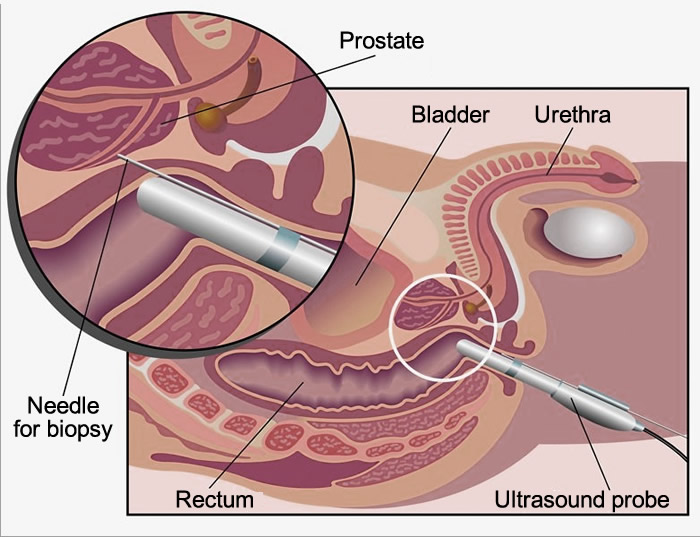 tipos de biópsia da próstata)