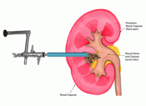 nefrolitotripsia percutânea