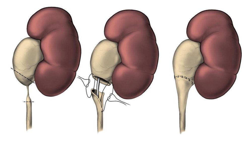 Pieloplastia robótica como tratamento da estenose de JUP!