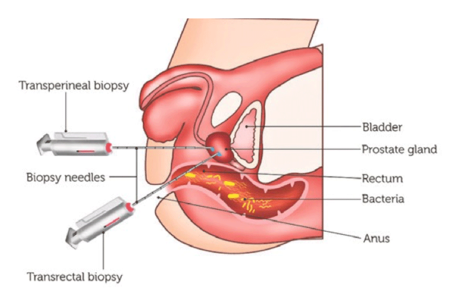 biopsia de prostata transperineal tecnica)