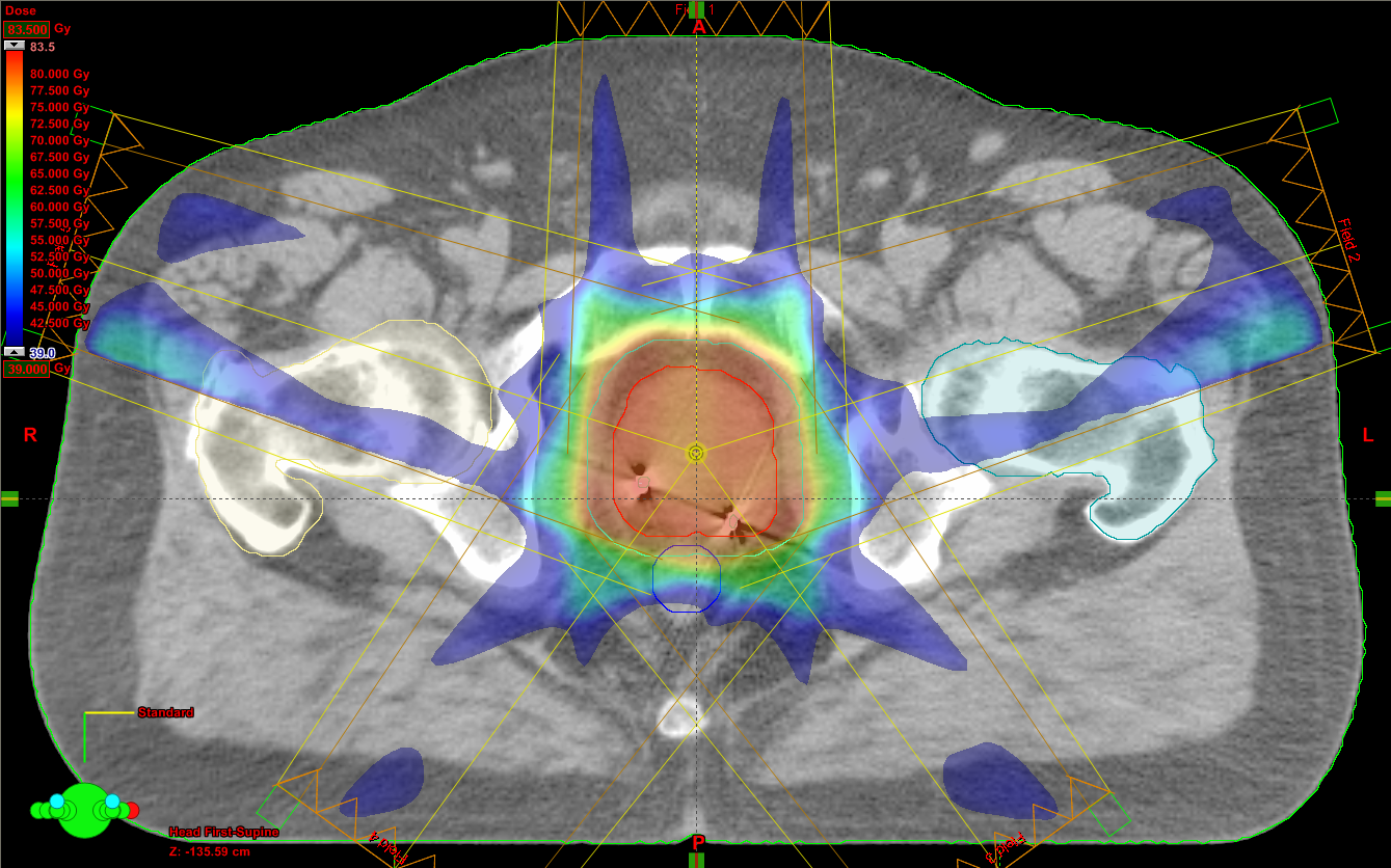radioterapia de próstata IMRT