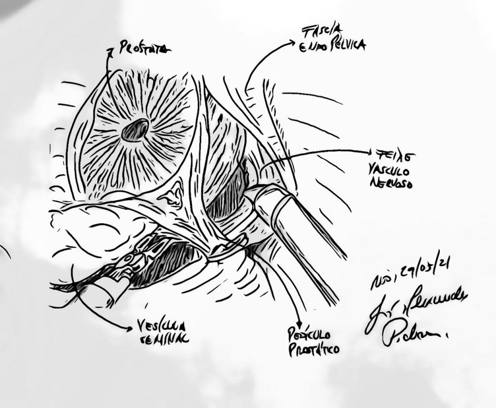 Cirurgia Robótica da Próstata – hoje